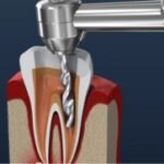 root canal